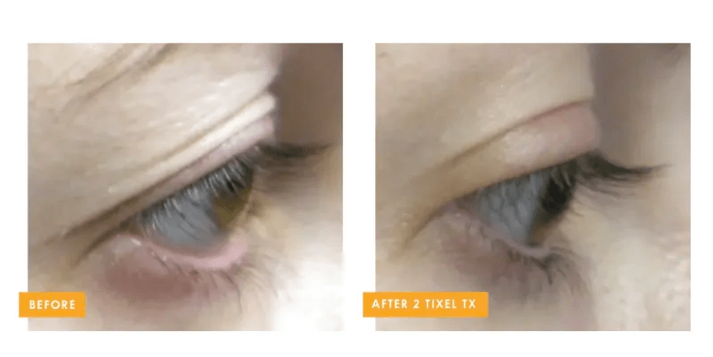 Tixel 2® eyelid rejuvenation before and after reducing fine lines and tightening eyelid skin at Back to 30 in South Carolina