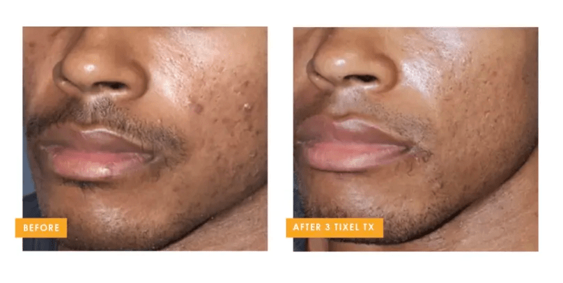 Tixel 2® fractional skin rejuvenation before and after showing improvement in acne scars and skin texture at Back to 30 in South Carolina