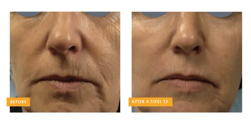 Tixel 2® fractional skin rejuvenation before and after results showing smoother lower face skin at Back to 30 in South Carolina