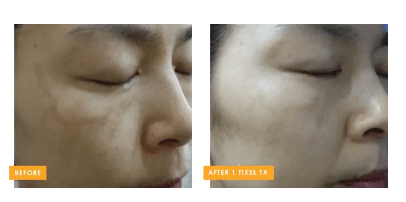 Tixel 2® fractional skin rejuvenation before and after improving uneven skin tone and texture at Back to 30 in South Carolina