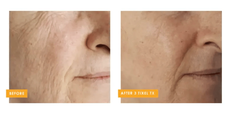 Tixel 2® fractional skin rejuvenation before and after improvement in nasolabial folds at Back to 30 in South Carolina