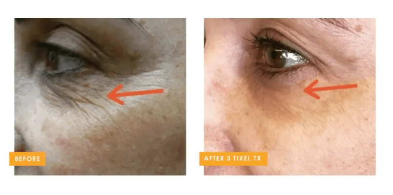 Tixel 2® fractional skin rejuvenation before and after crow’s feet wrinkle reduction at Back to 30 in South Carolina